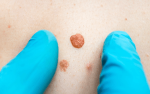 are genital warts always std