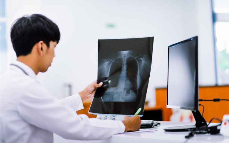can chest x rays show lung cancer