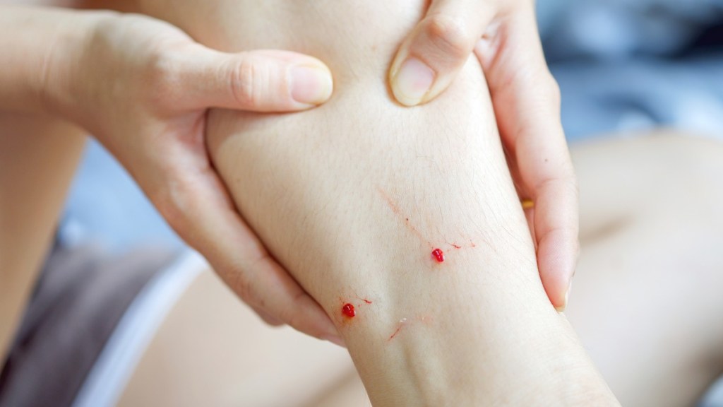 Wellness Tips from Josef Schenker, MD | Treating Animal Bites - Centers ...