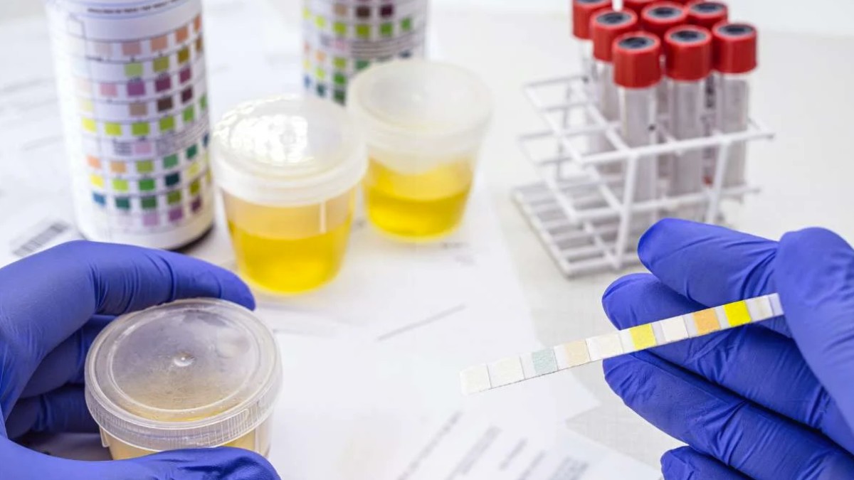 is urobilinogen in urine normal