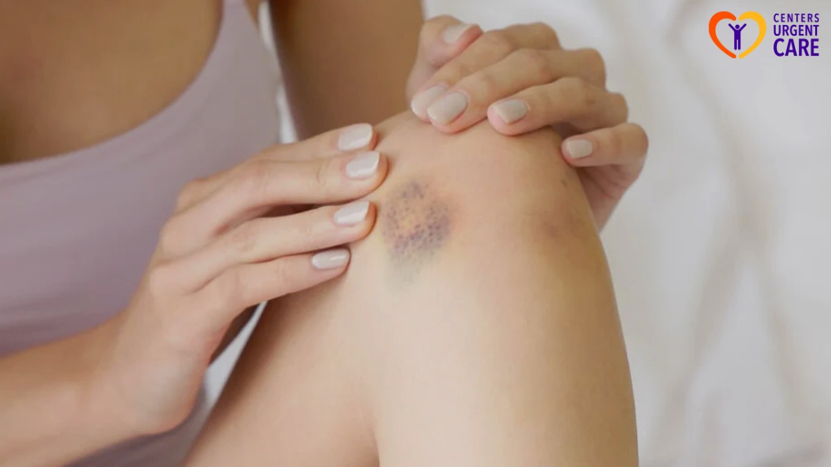 signs of internal bleeding