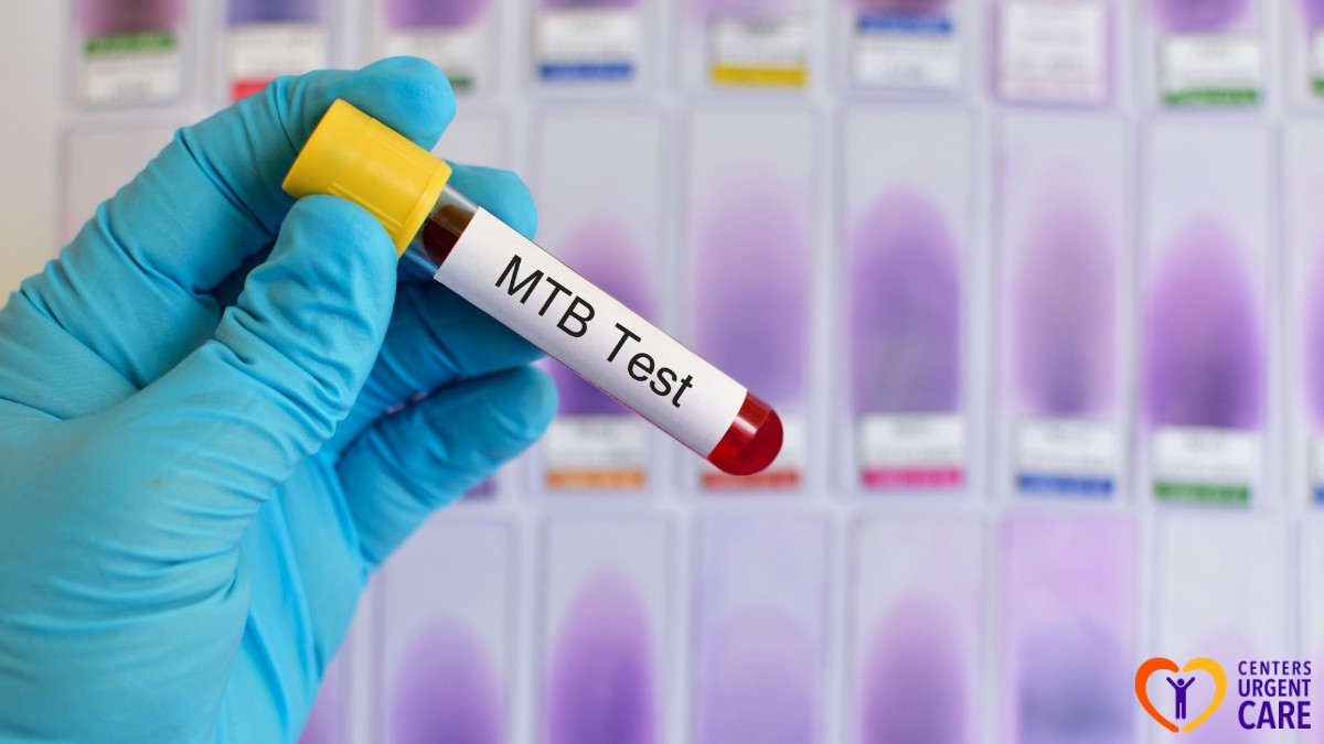 tuberculosis testing
