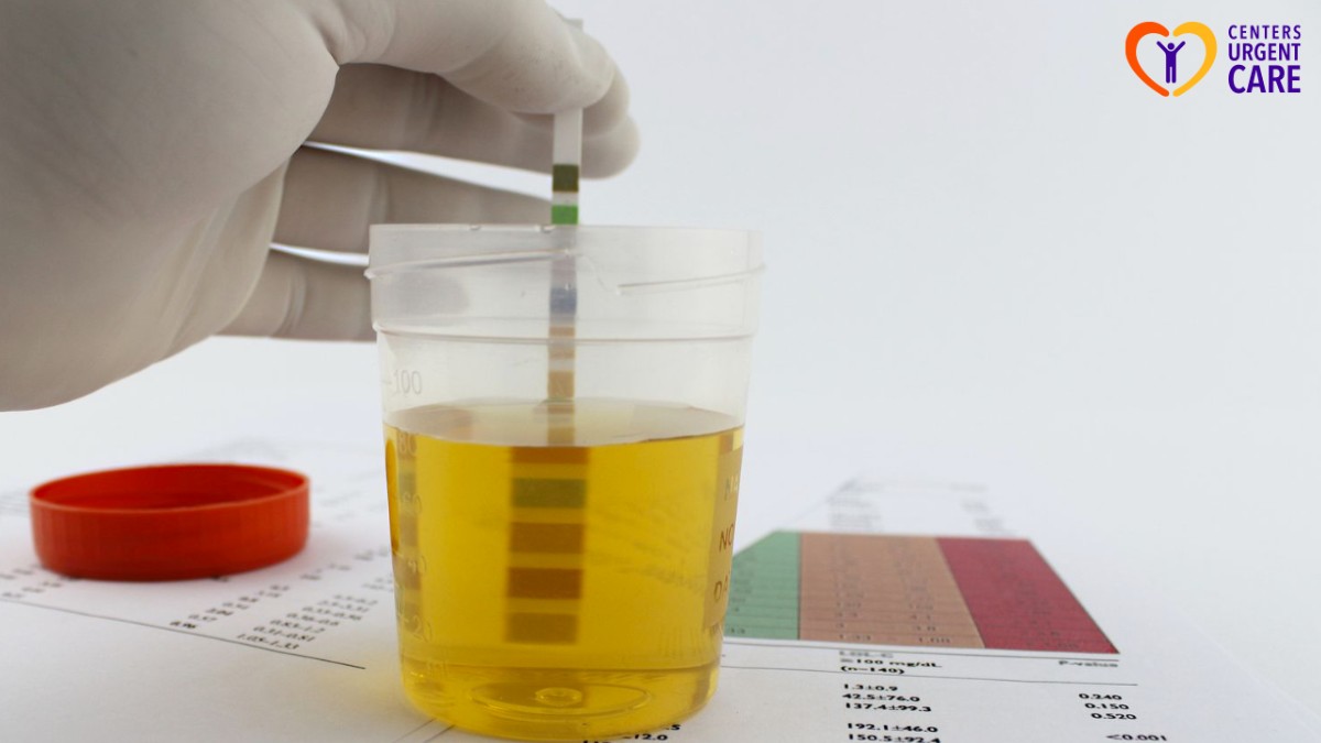 proteinuria in urinalysis