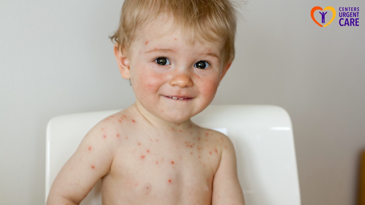 chickenpox symptoms in children
