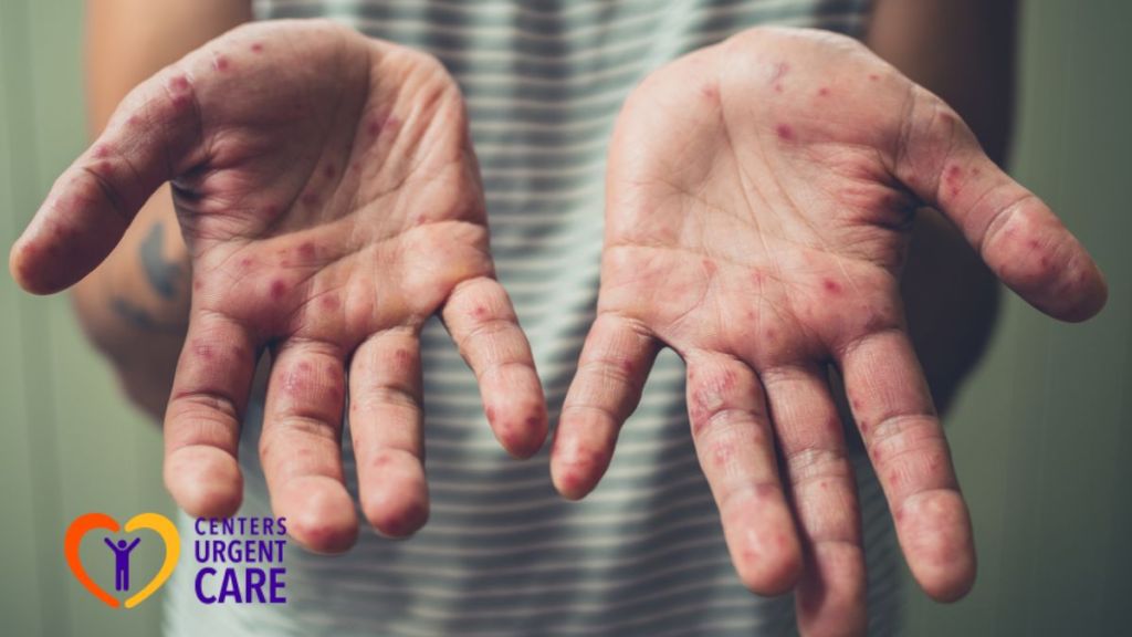 hand-foot-and-mouth-disease-treatment-and-management