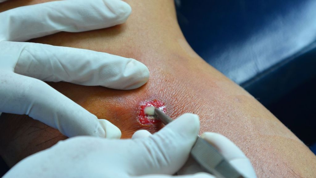 skin-abscess-treatment