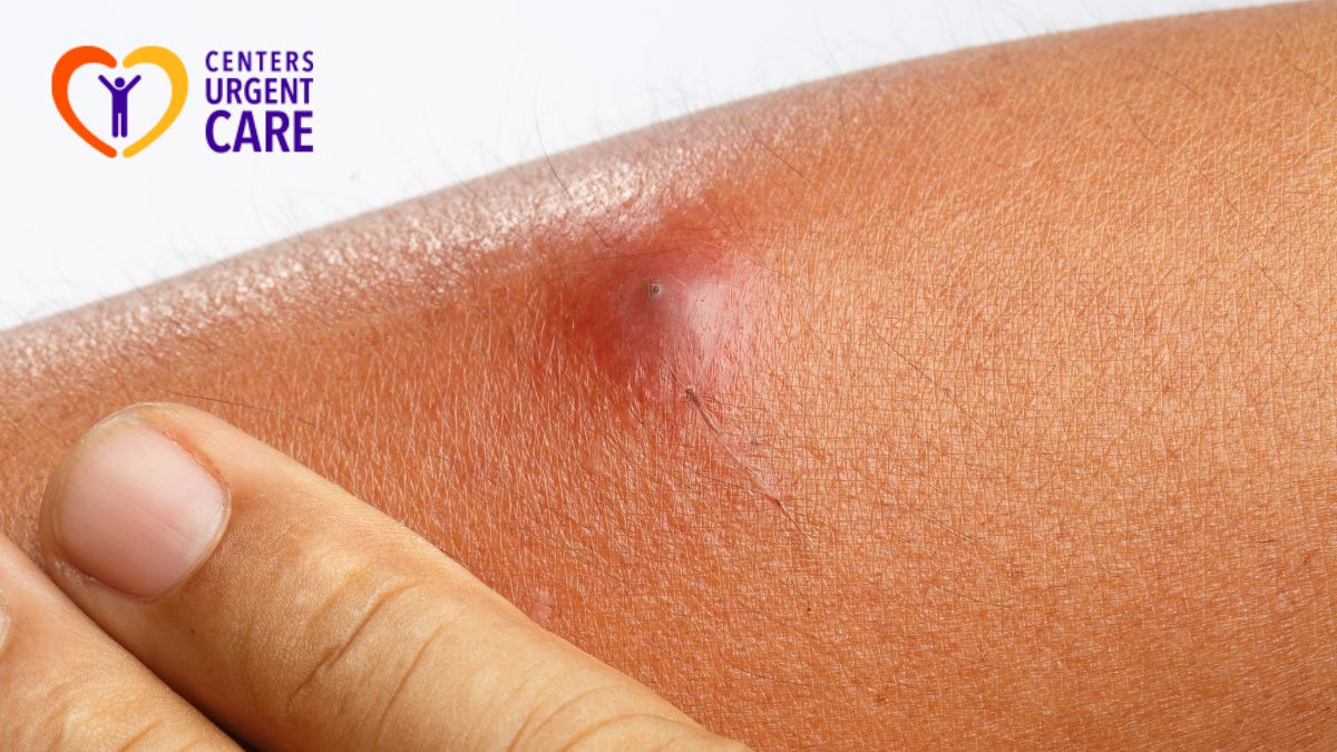 skin-abscess-treatment-and-management