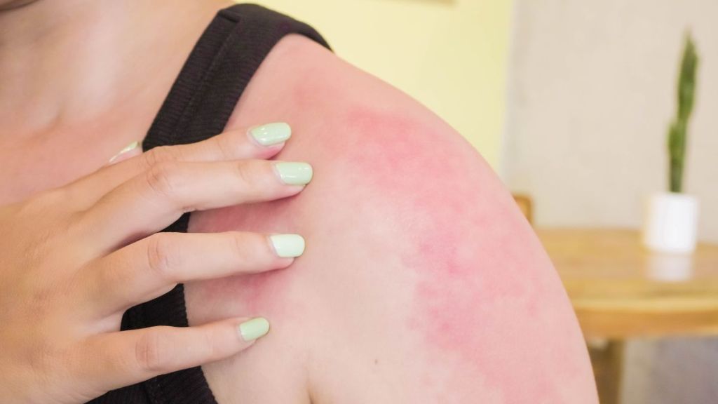 sunburn