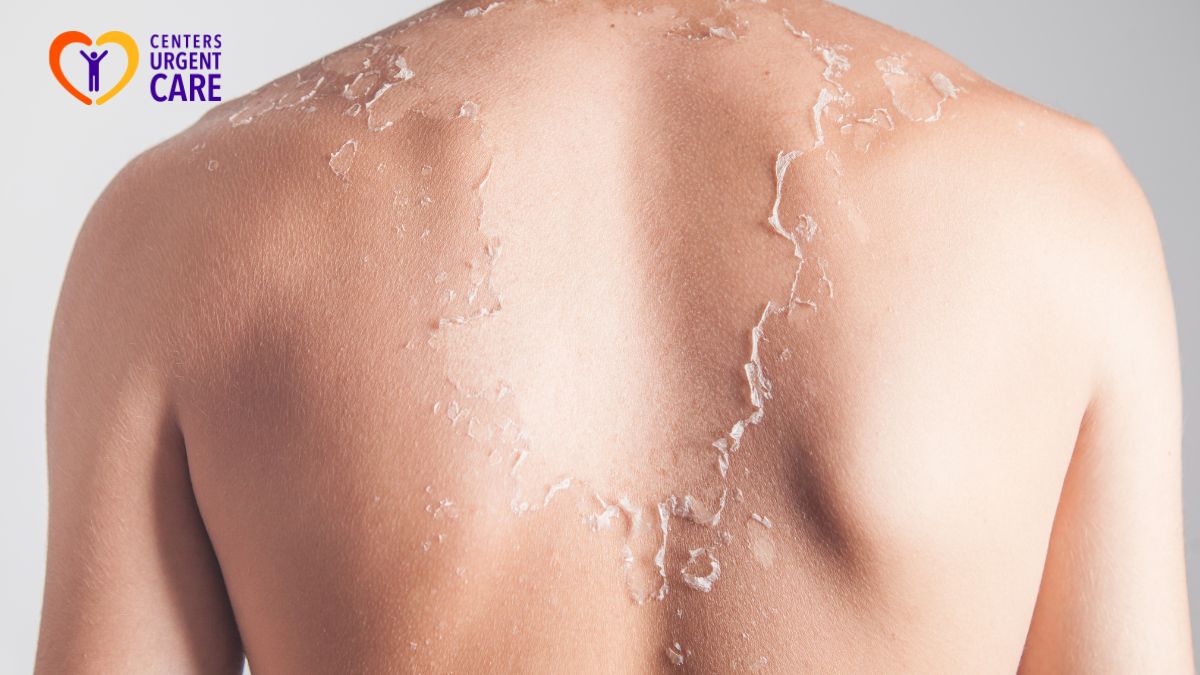 sunburn-treatment-and-prevention