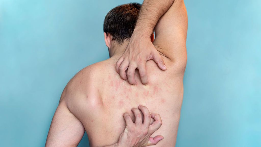 what-causes-scabies